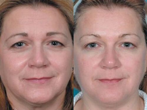 photos before and after plasma skin rejuvenation