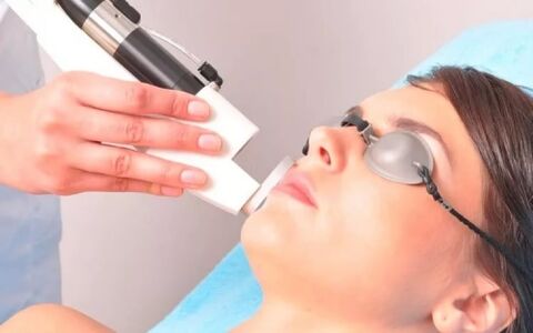 Effects on facial skin with a laser device