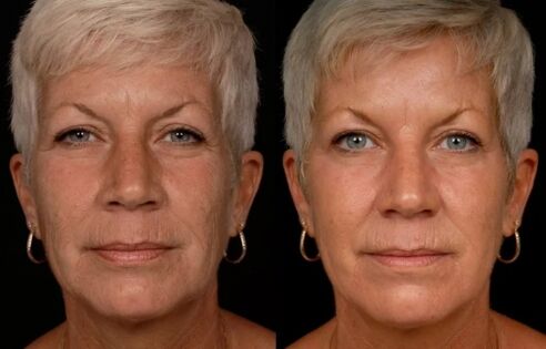 The result of laser treatment of facial skin - wrinkle reduction
