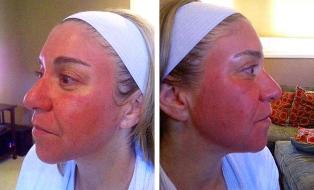 Facial redness after laser rejuvenation