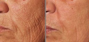photo before and after fractional skin rejuvenation
